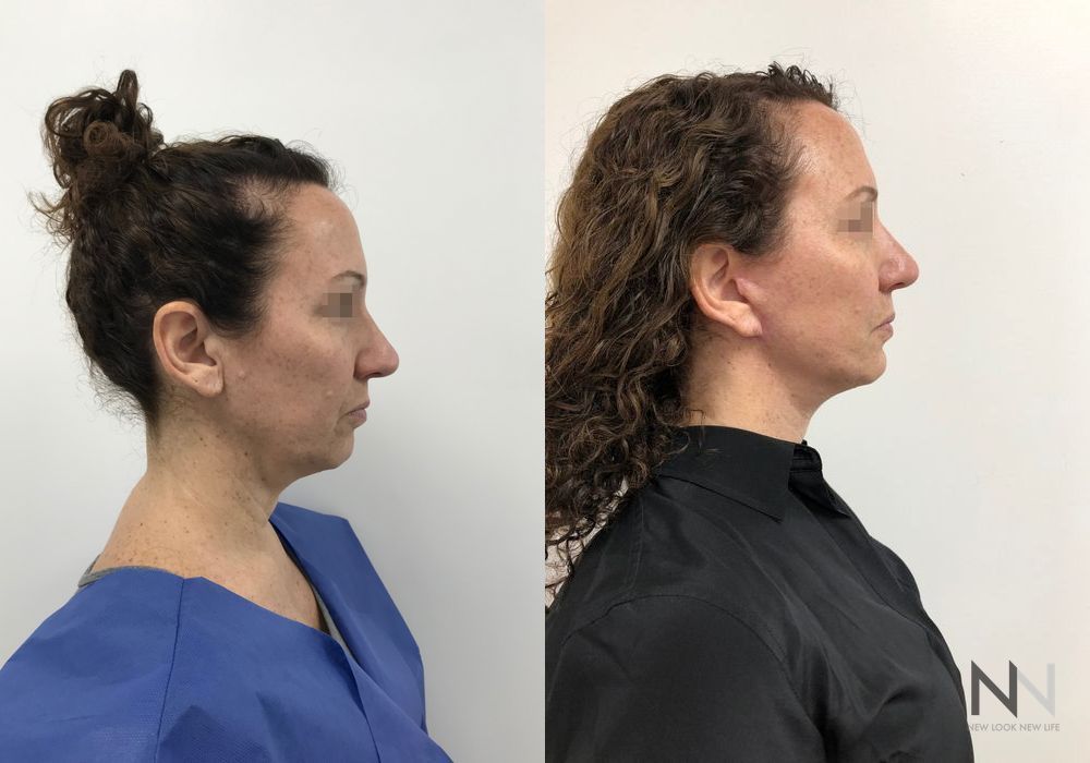 Facelift - Thumbnail 5