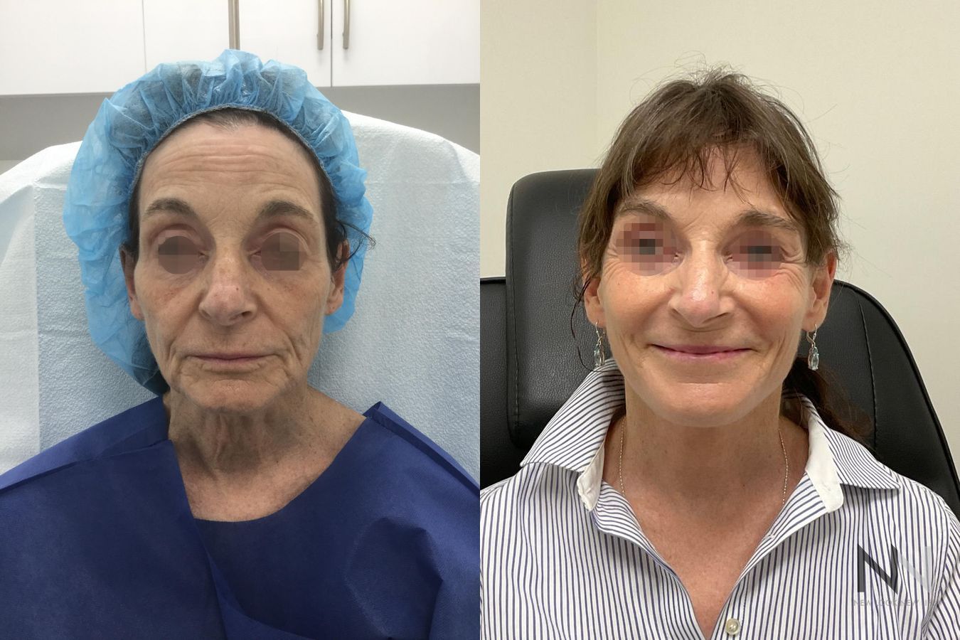 Before and after facelift and neck lift six months results