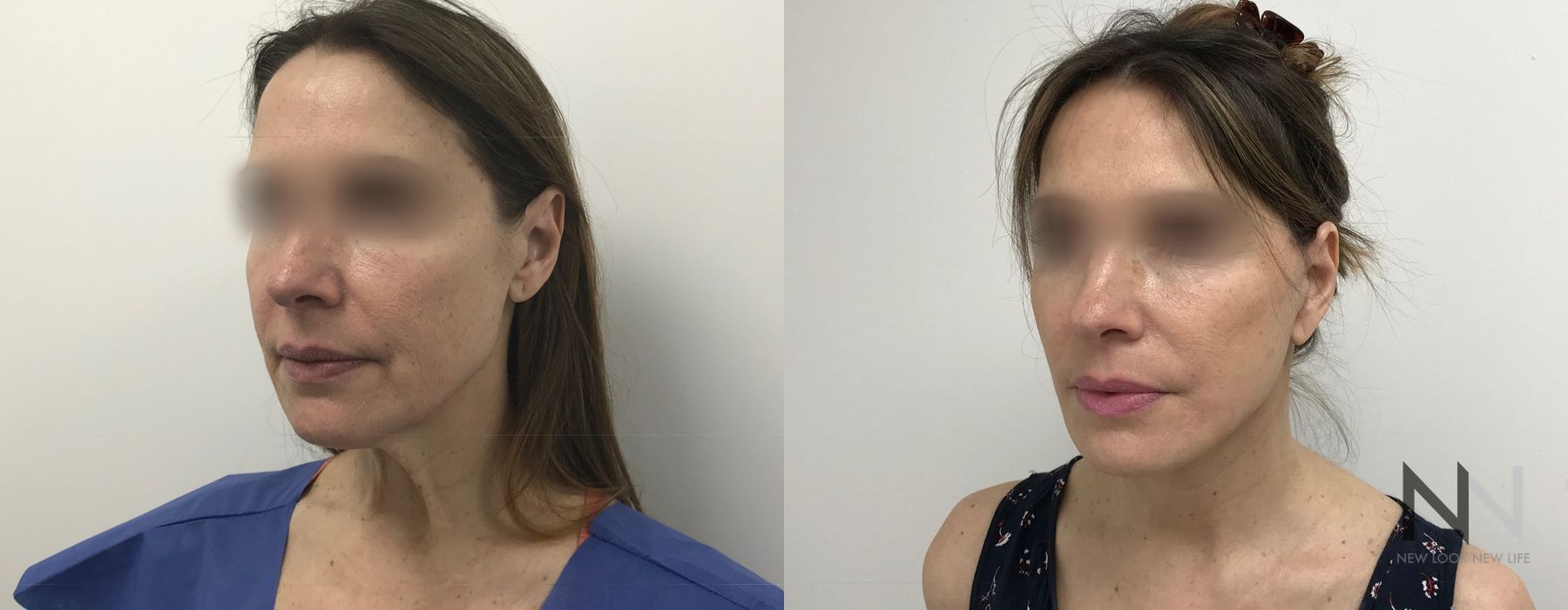 Facelift - Thumbnail 3