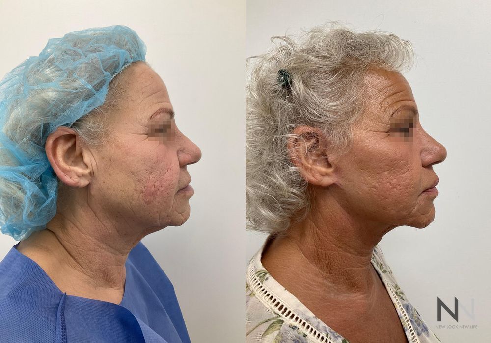 Facelift - Thumbnail 2