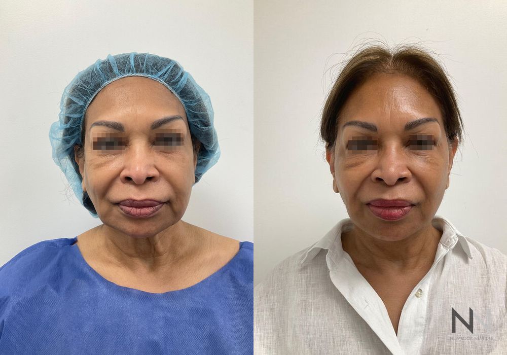 Facelift - Case 2163