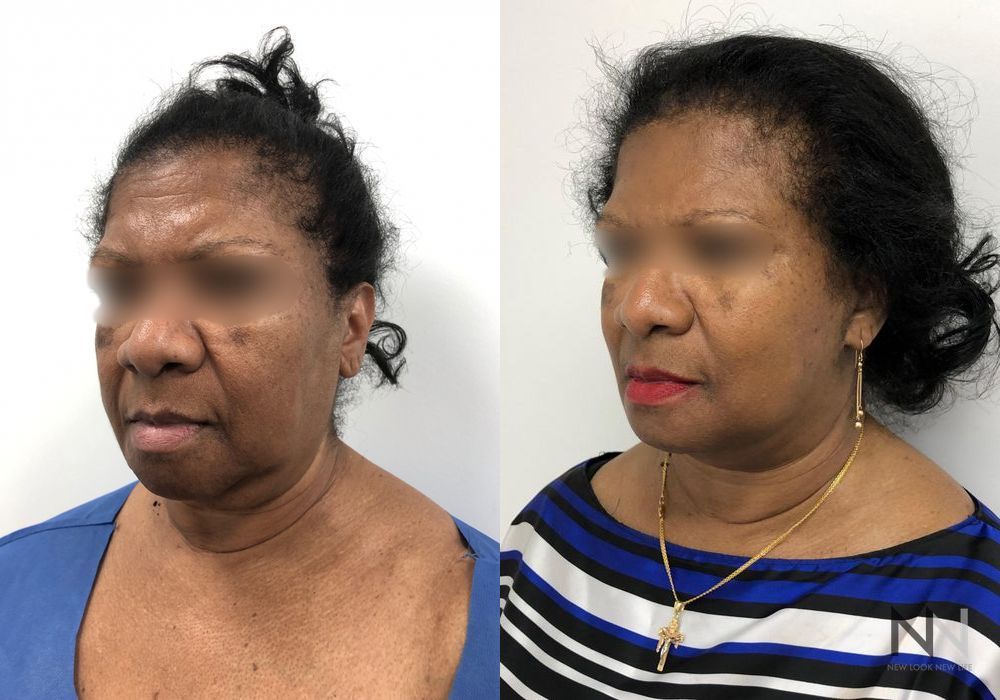 Facelift - Thumbnail 3