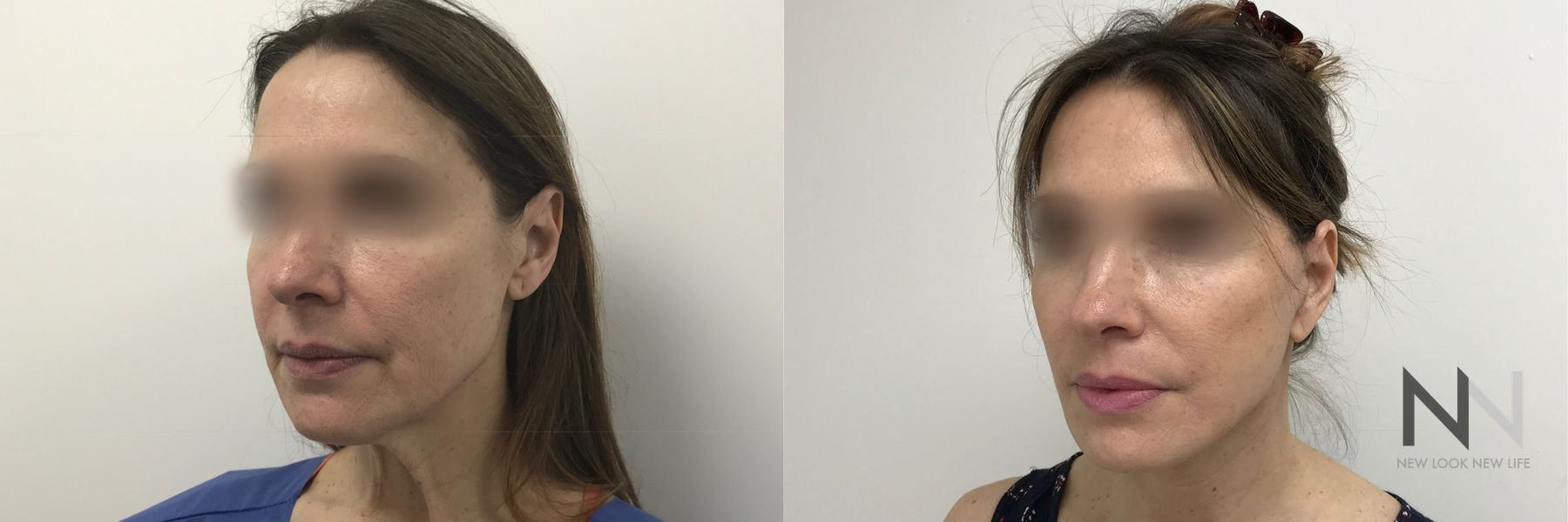 Before and after facelift with fat grafting results - Angle 3