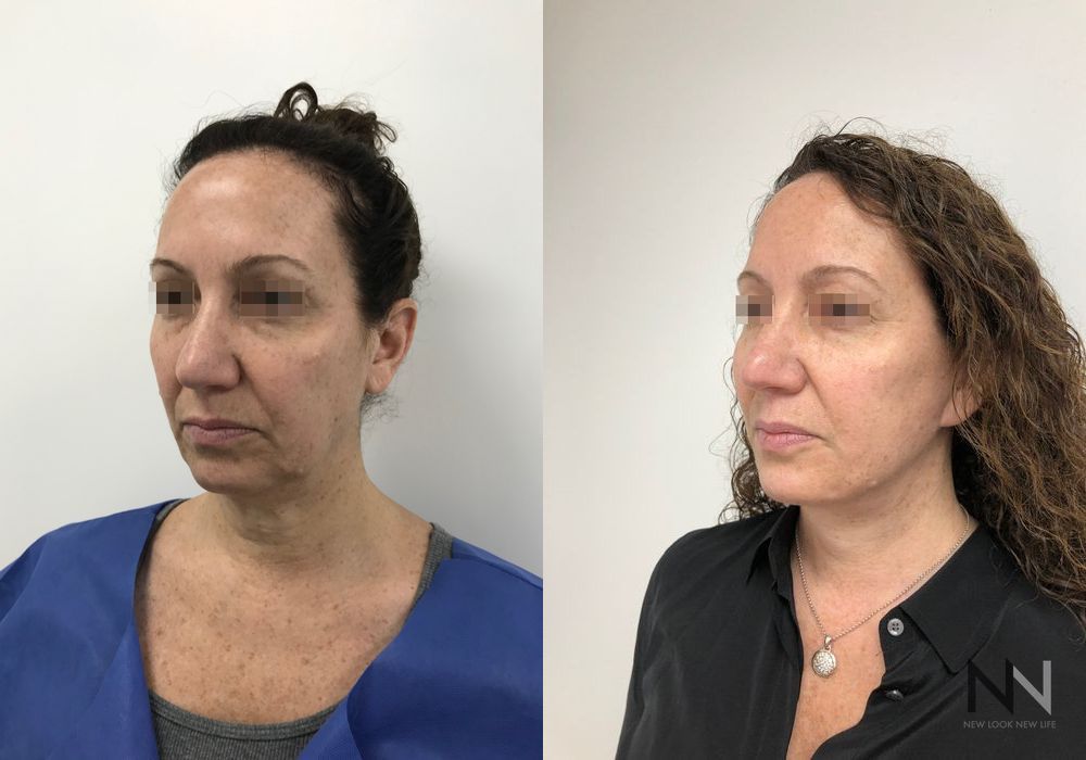 Facelift - Case 1634