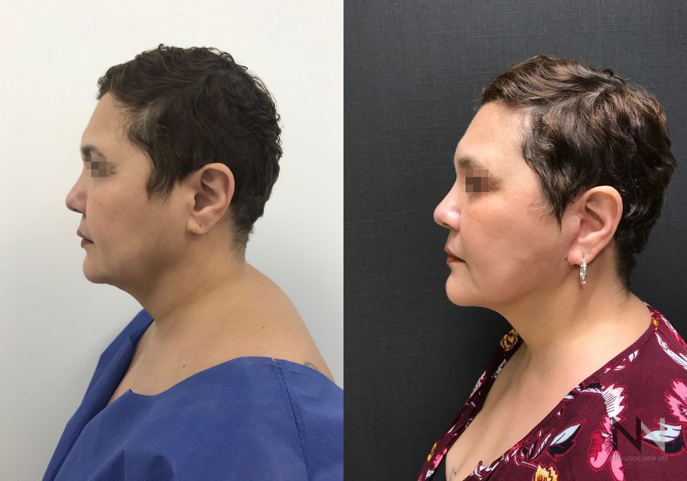 Facelift - Thumbnail 3