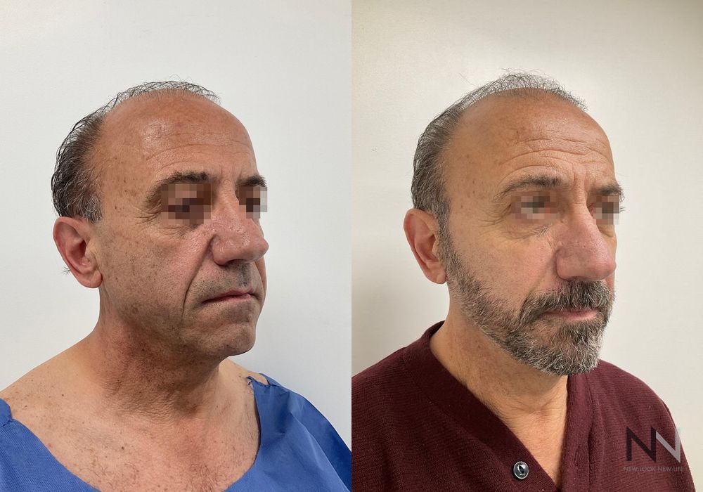 Facelift - Thumbnail 2