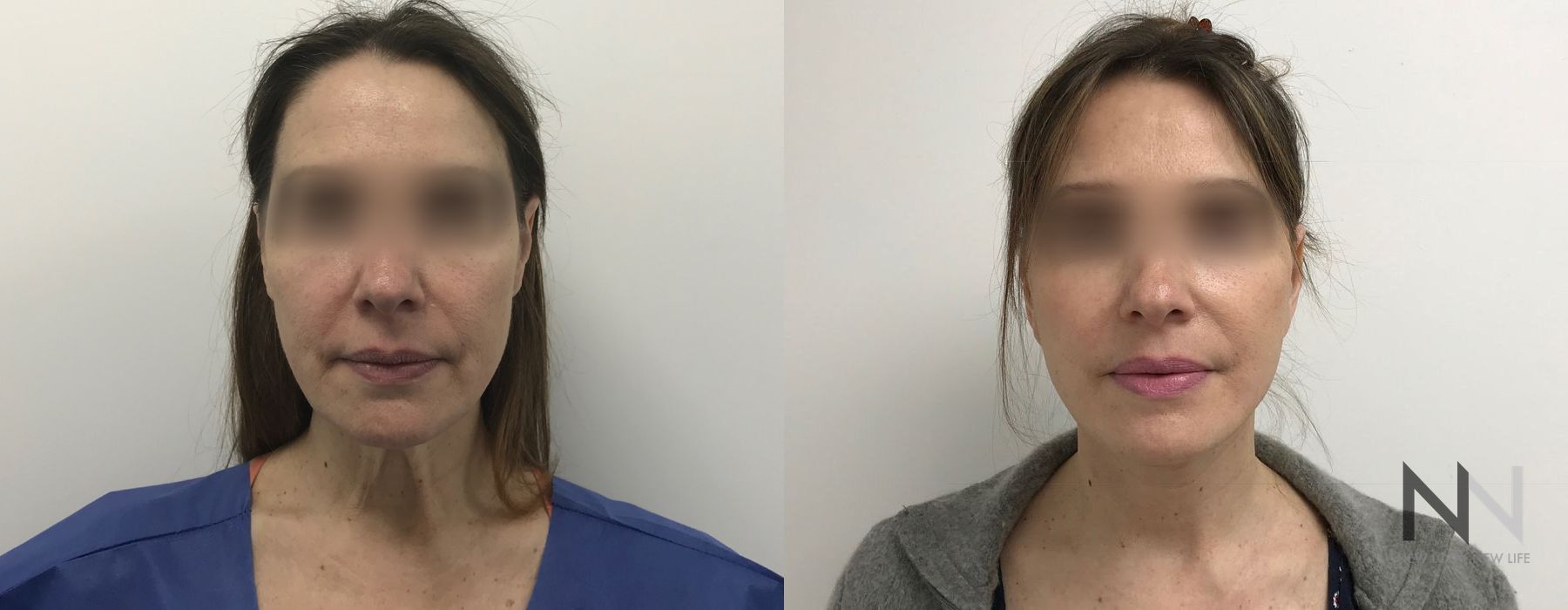 Facelift - Thumbnail 2