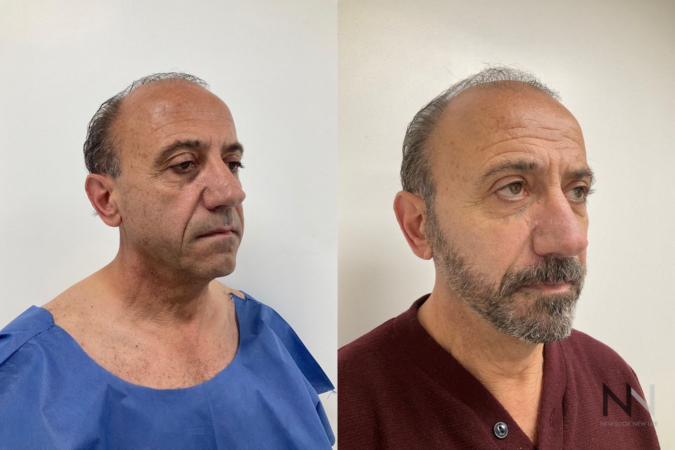 Before and after male neck lift six months results