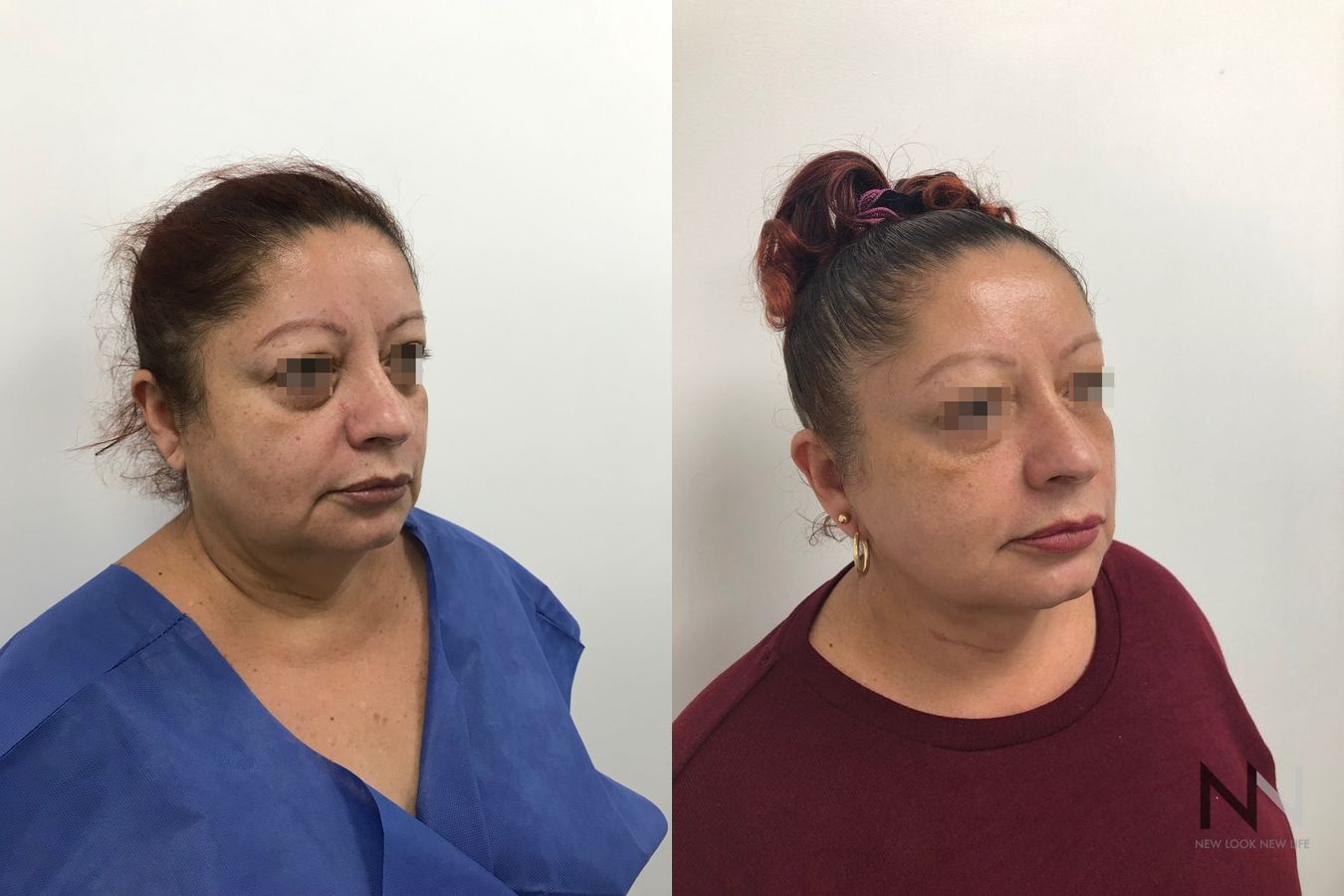 Before and after mini facelift with fat grafting and Halo laser - Angle 2
