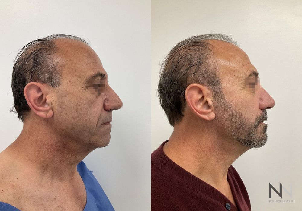 Facelift - Thumbnail 3