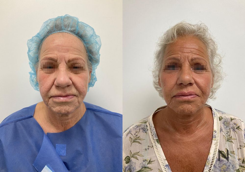 Facelift - Thumbnail 3