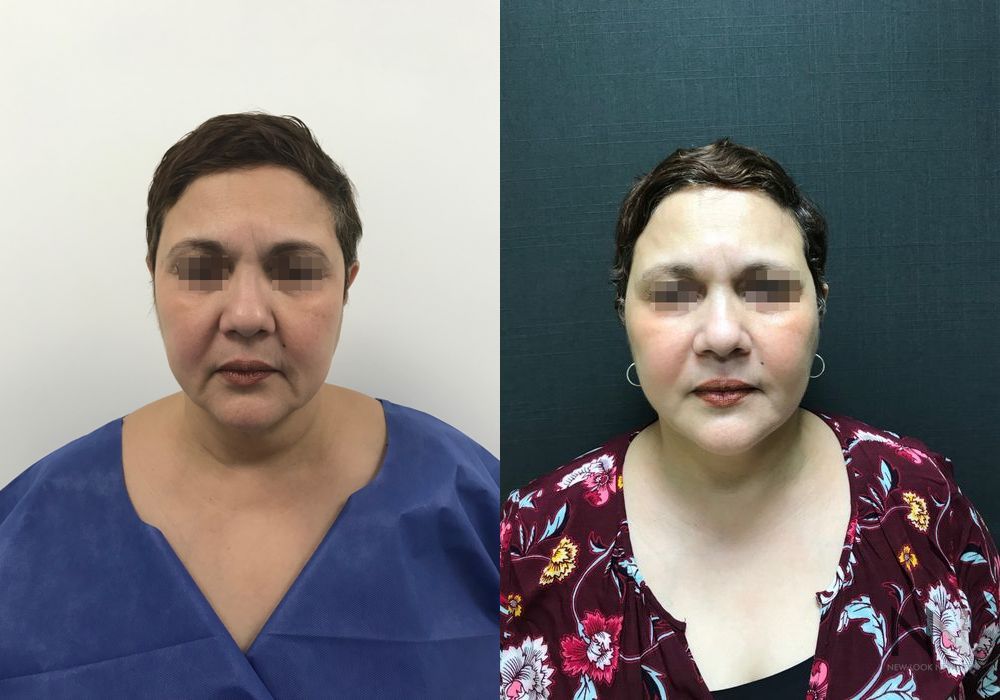 Facelift - Thumbnail 4