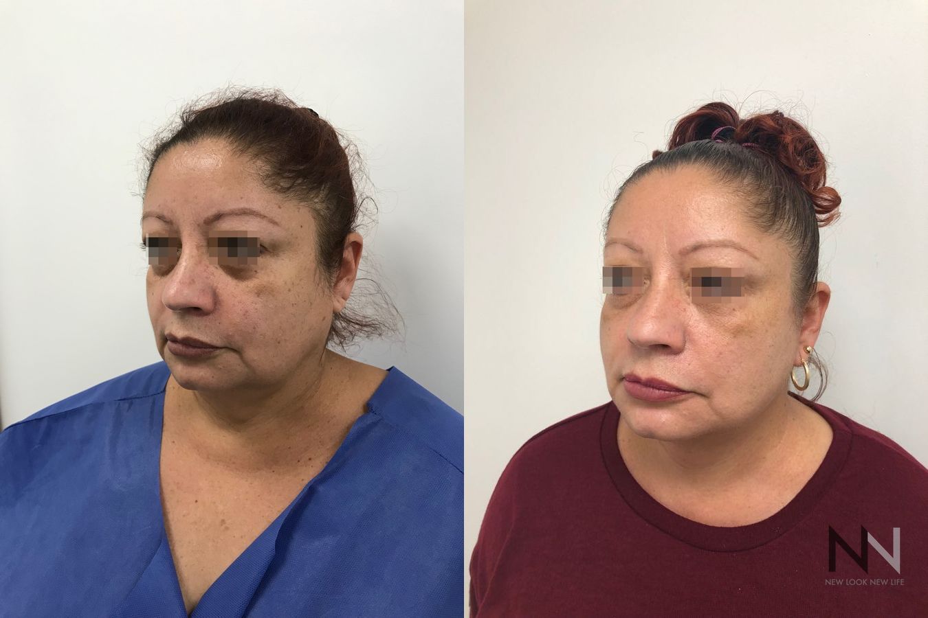 Before and after mini facelift with fat grafting and Halo laser - Angle 4