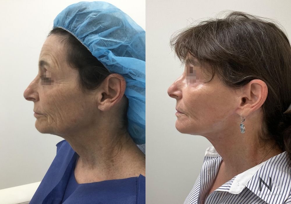 Facelift - Thumbnail 2