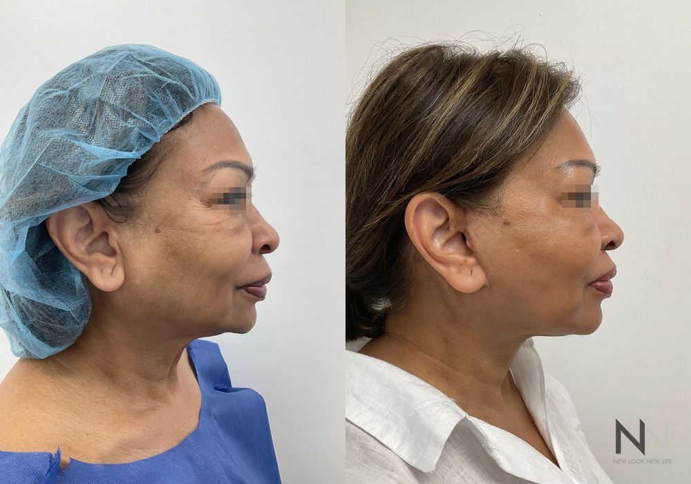 Facelift - Thumbnail 3