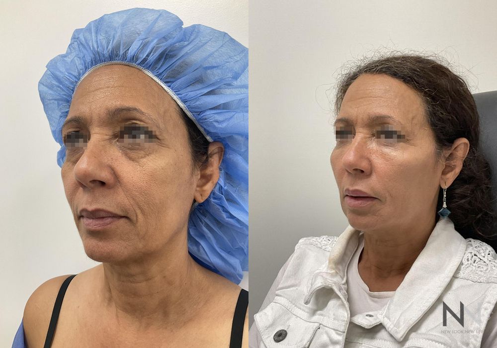 Fat Grafting - Thumbnail 2