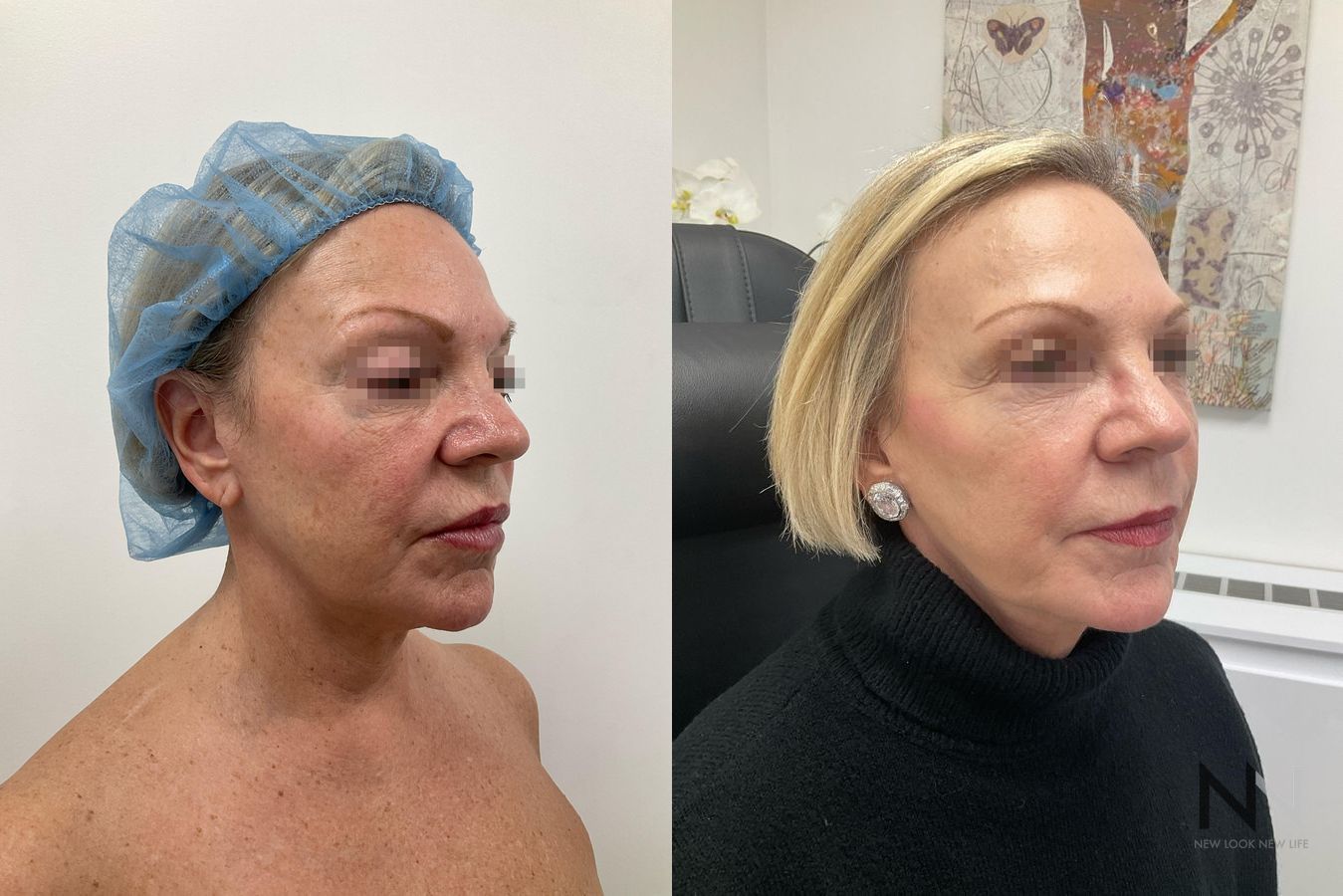 Fat grafting showing cheek and under-eye volume restoration - Angle 3
