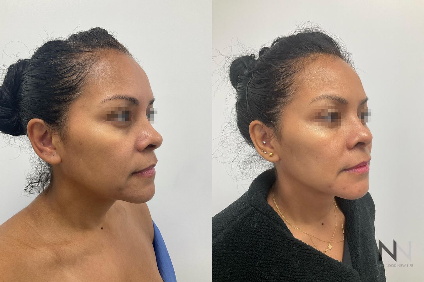 Cheek fullness improvement after fat grafting - Angle 3
