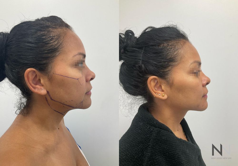 Fat Grafting - Thumbnail 4