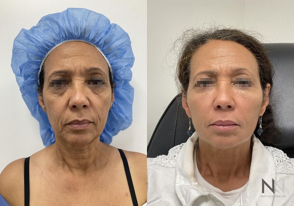 Fat Grafting - Case 1642