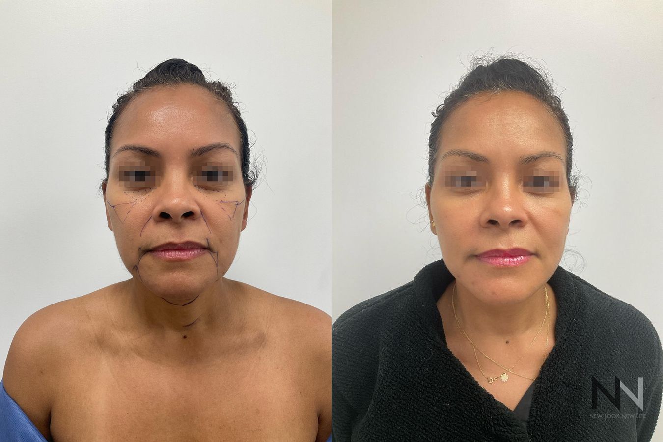 Cheek fullness improvement after fat grafting