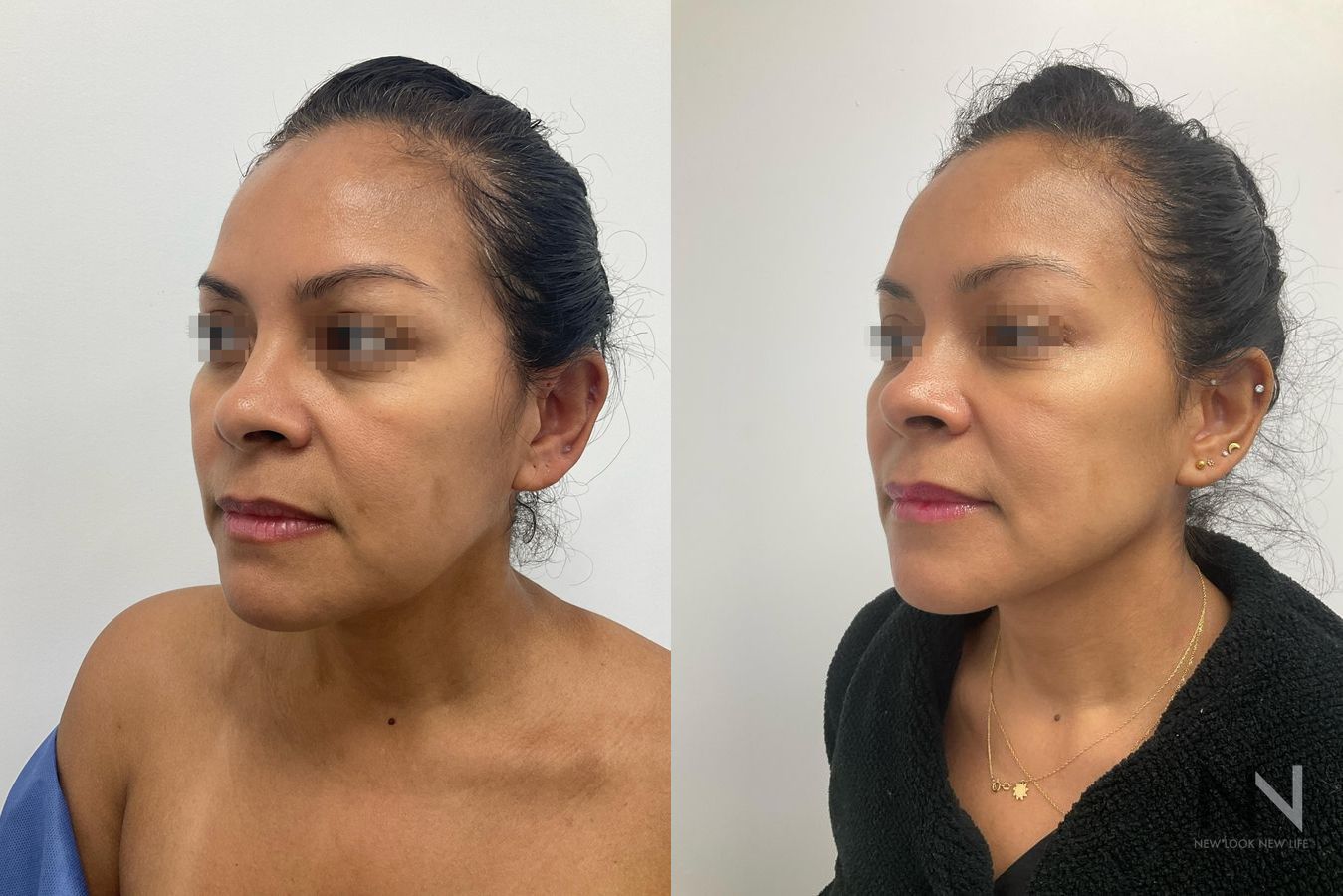 Cheek fullness improvement after fat grafting - Angle 2