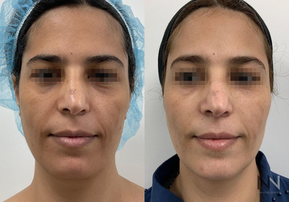 Fat Grafting - Case 2175