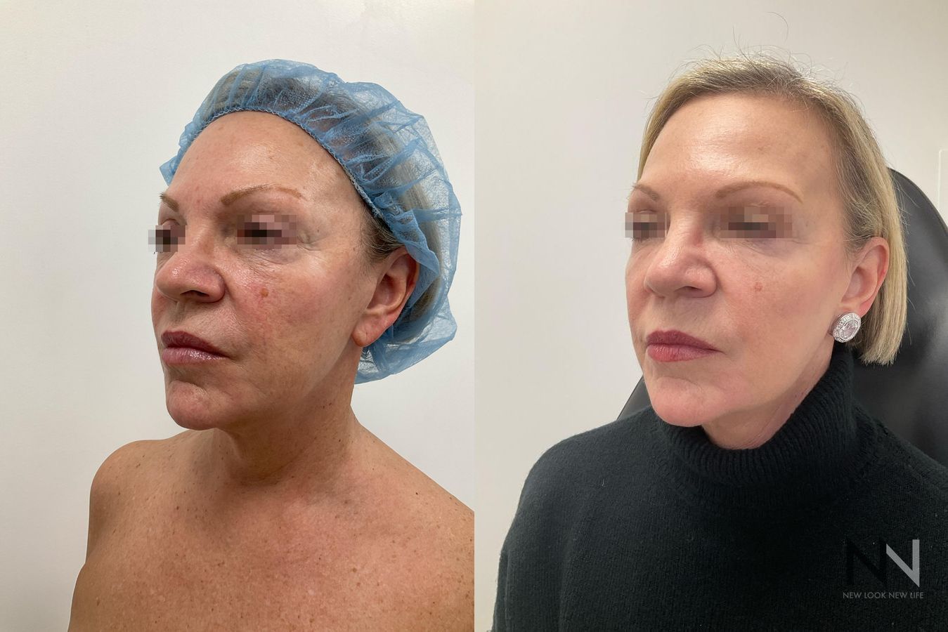 Fat grafting showing cheek and under-eye volume restoration
