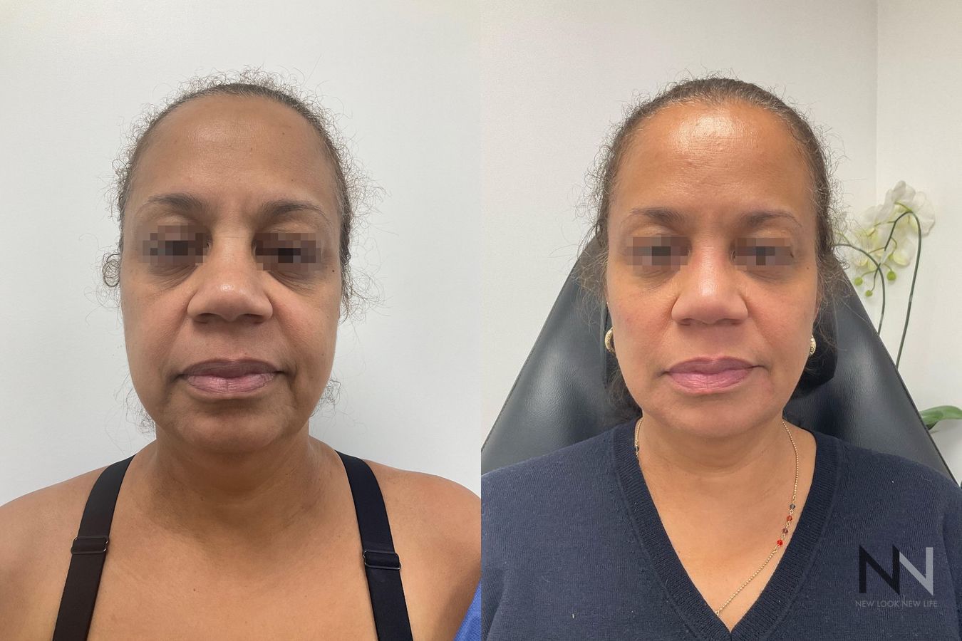 Before and after facial fat grafting four months results - Angle 2