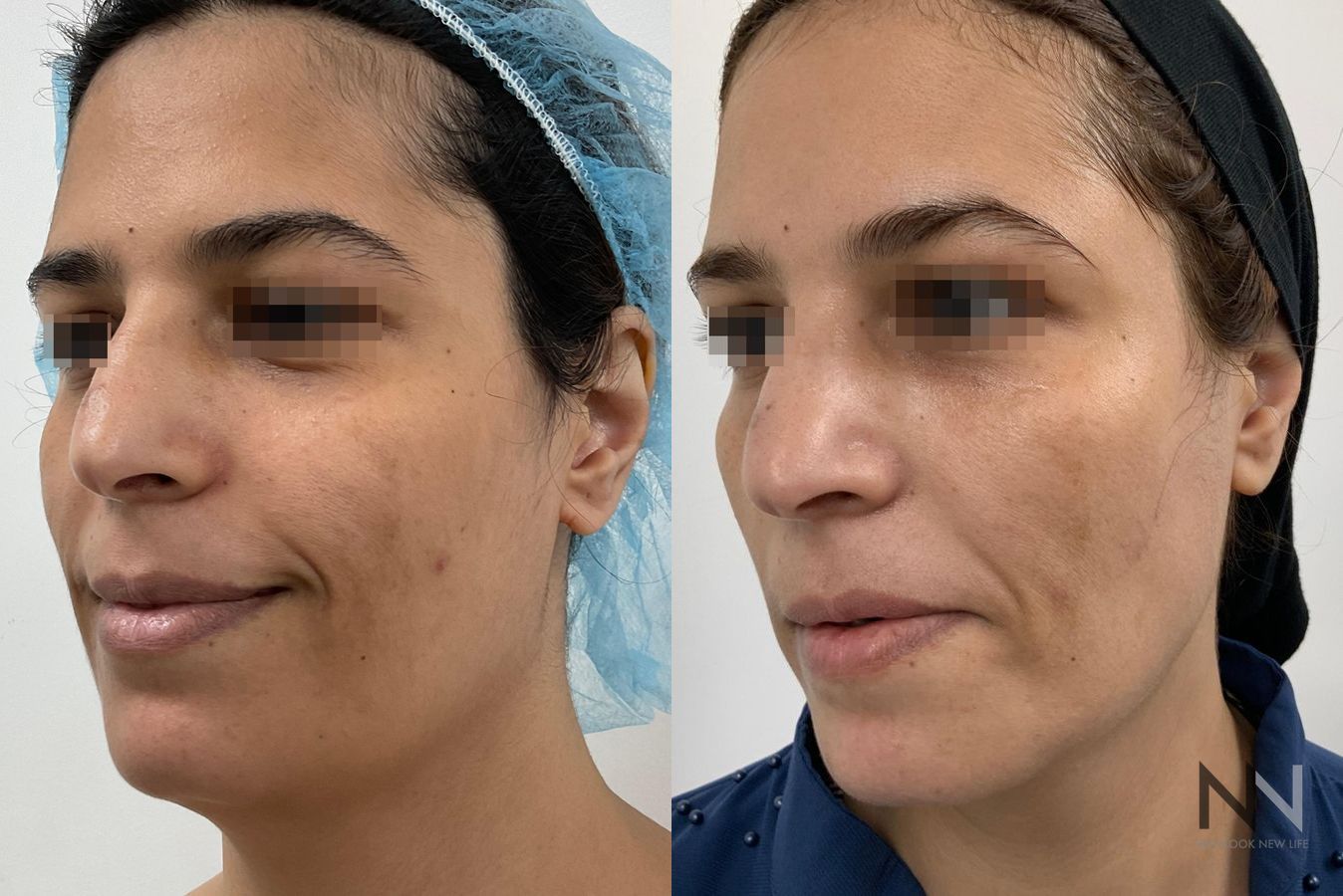 Fat grafting showing improved facial volume and contour - Angle 2