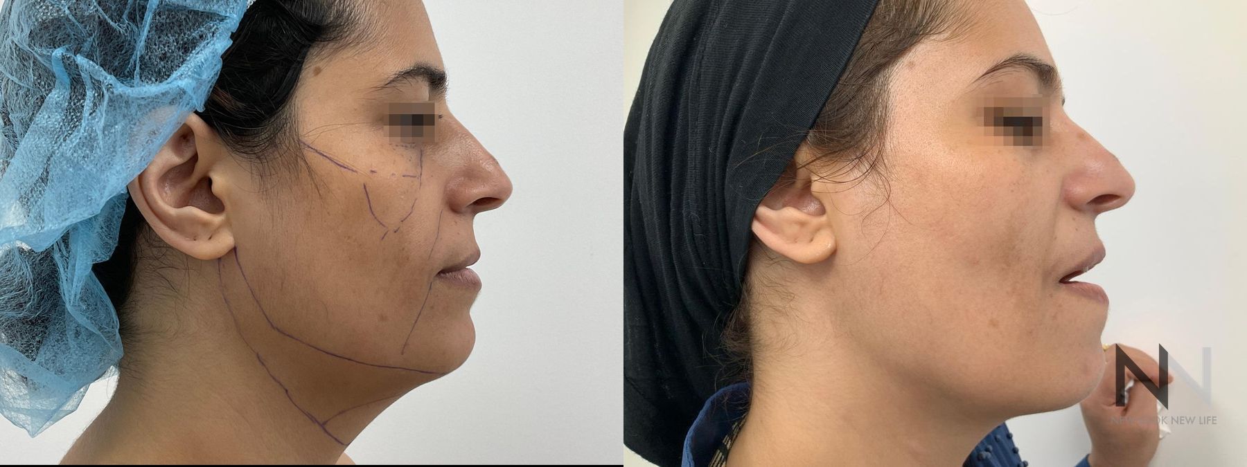 Fat grafting showing improved facial volume and contour - Angle 3