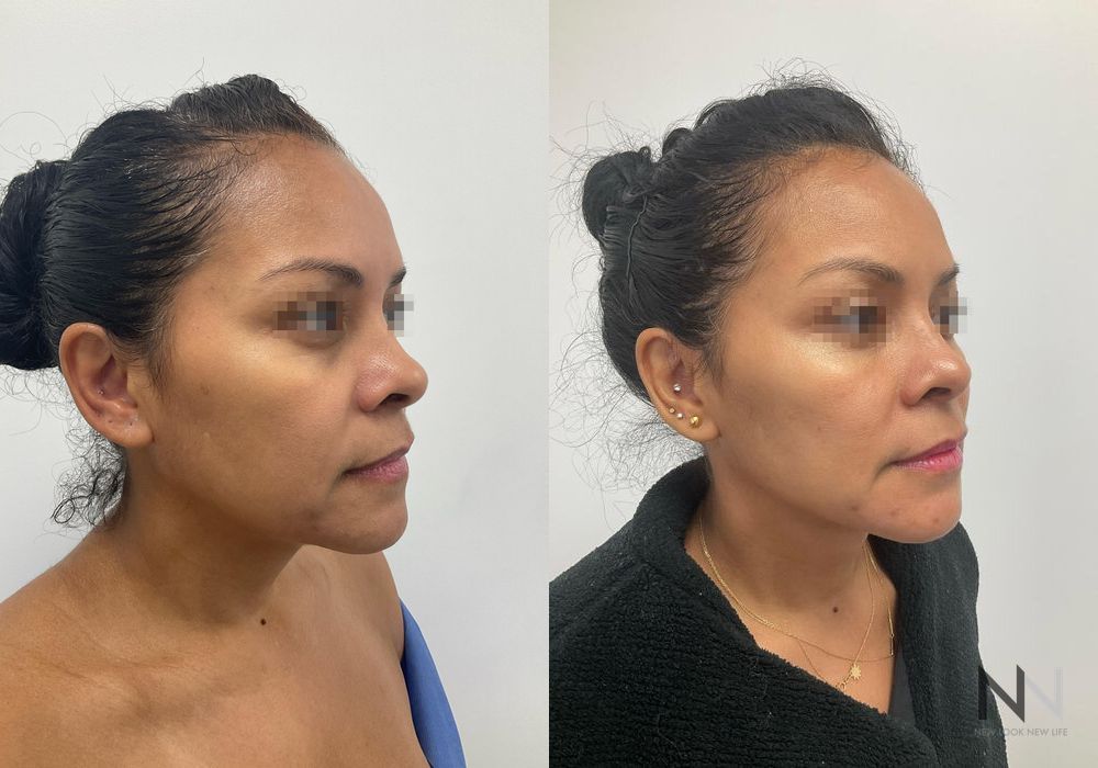 Fat Grafting - Thumbnail 3