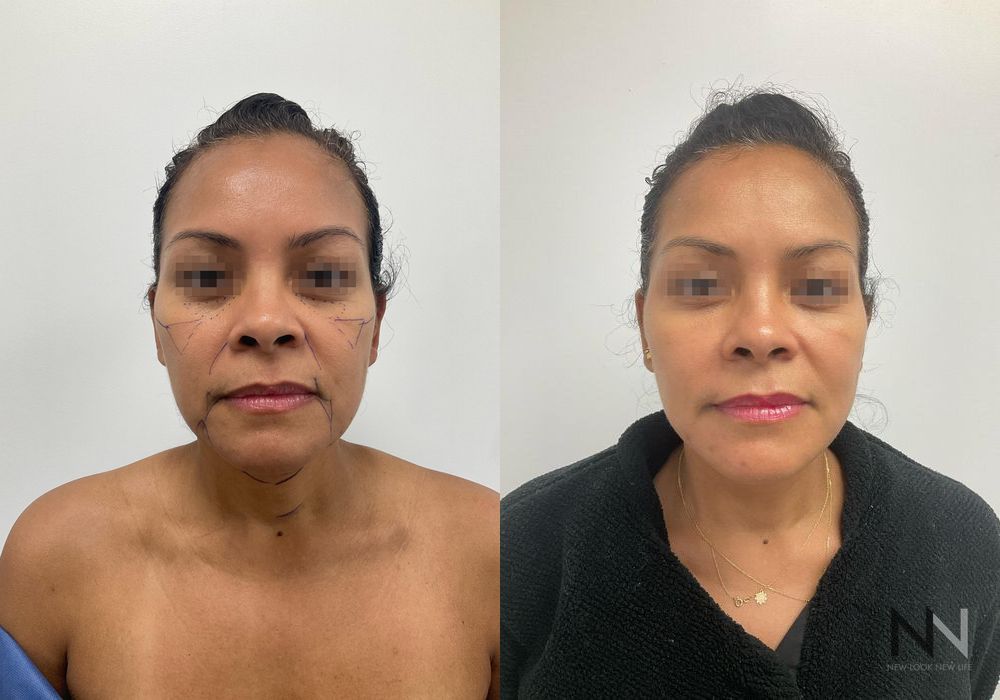 Fat Grafting - Case 2177