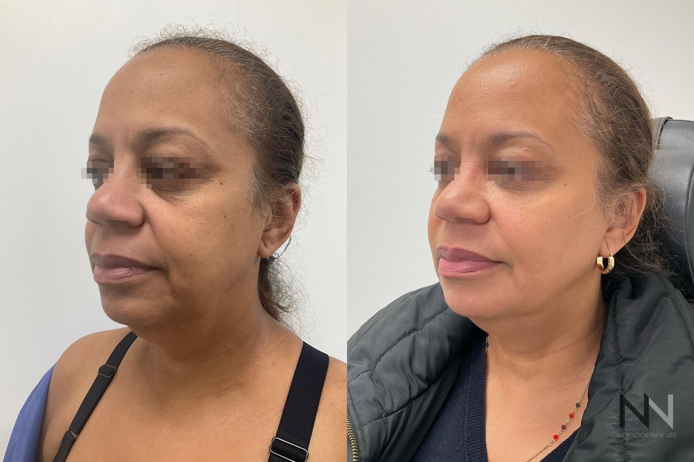 Before and after facial fat grafting four months results