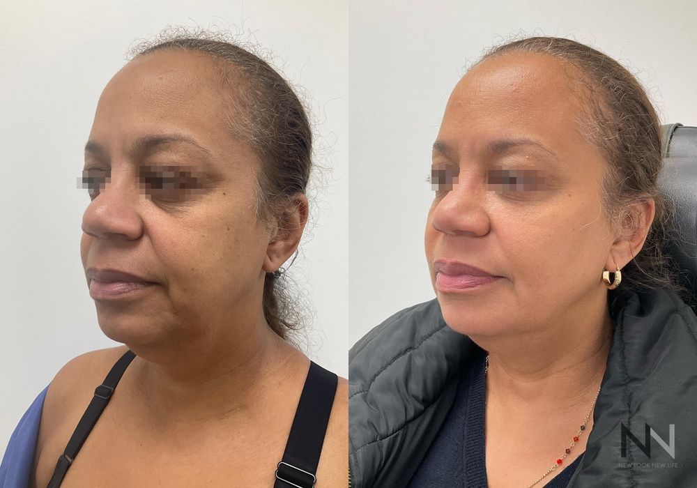 Fat Grafting - Thumbnail 2