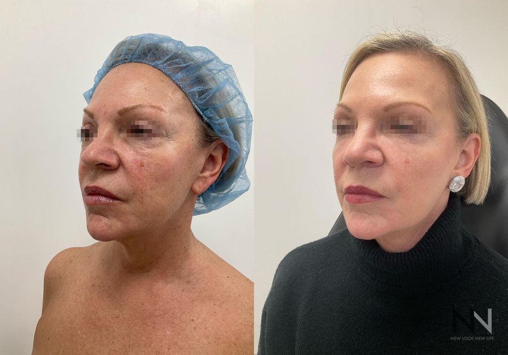 Fat Grafting - Thumbnail 2