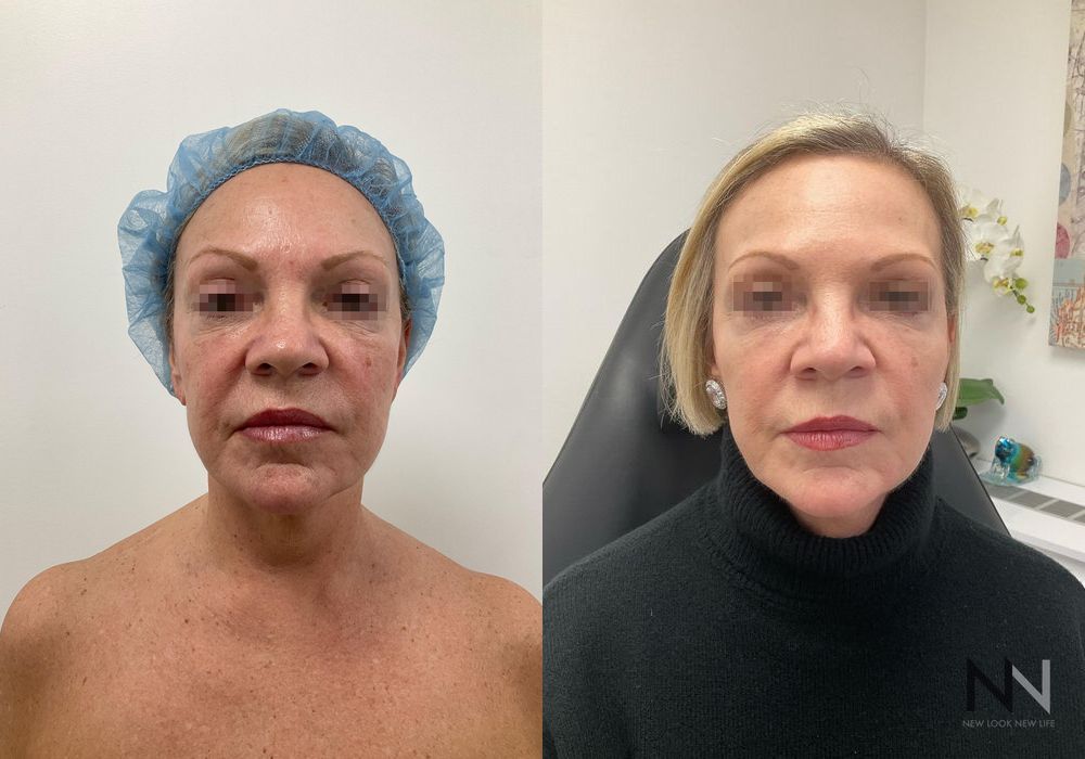 Fat Grafting - Case 1646