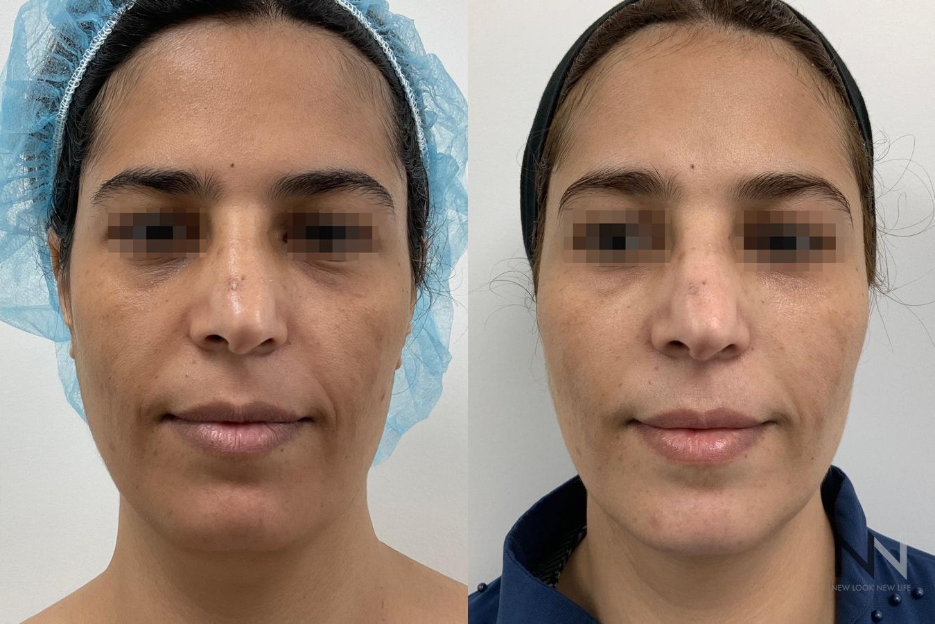 Fat grafting showing improved facial volume and contour