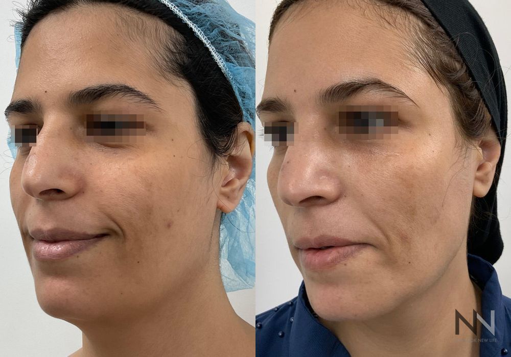 Fat Grafting - Thumbnail 2