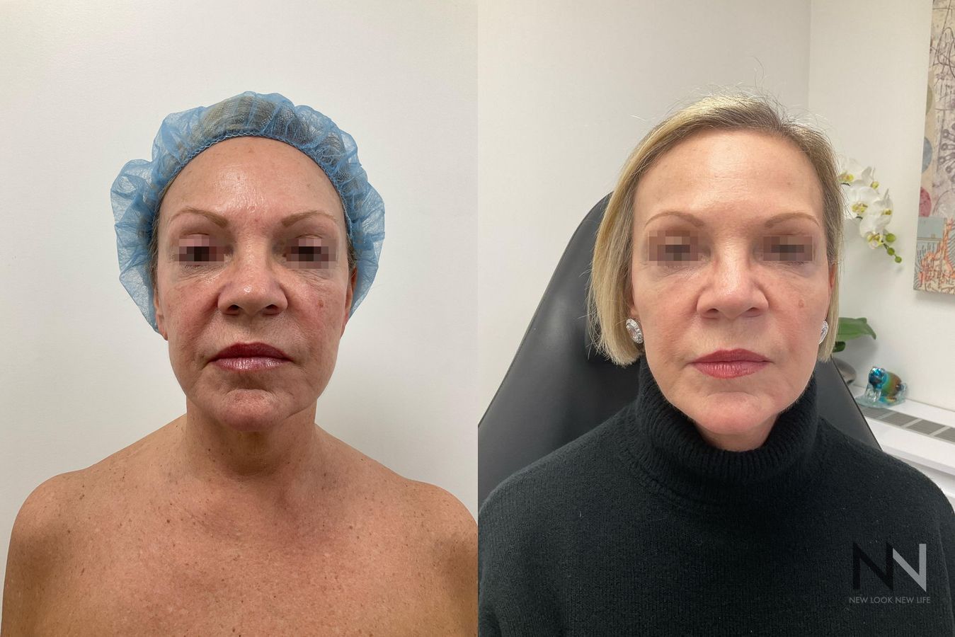 Fat grafting showing cheek and under-eye volume restoration - Angle 2