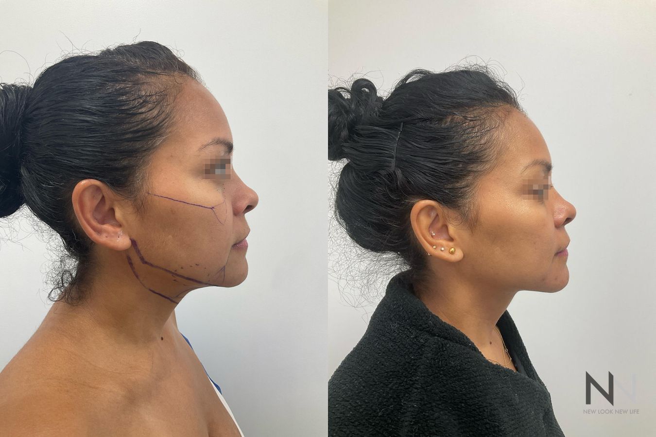 Cheek fullness improvement after fat grafting - Angle 4