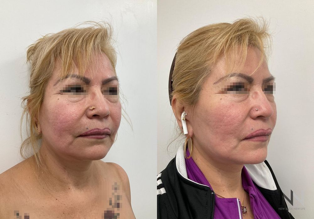 Fat Grafting - Case 2174