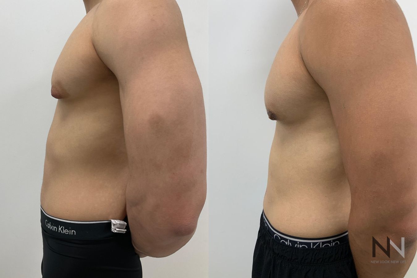 Before and after gynecomastia surgery four months results - Angle 5