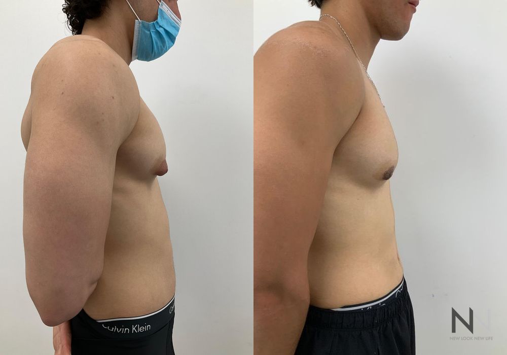 Gynecomastia - Thumbnail 3