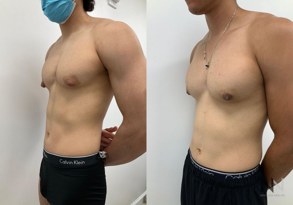 Gynecomastia - Thumbnail 4