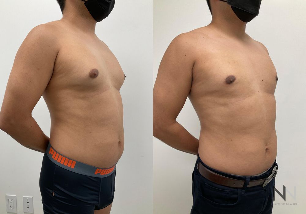 Gynecomastia - Thumbnail 4