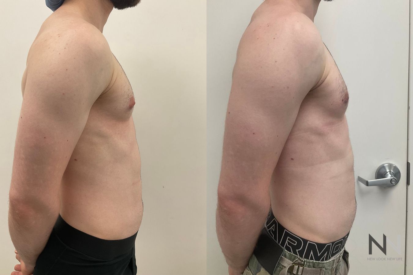 Before-and-after photos of gynecomastia surgery performed by Dr. Claudia Kim, showcasing male chest contouring with improved definition, symmetry, and a flatter chest appearance. - Angle 3