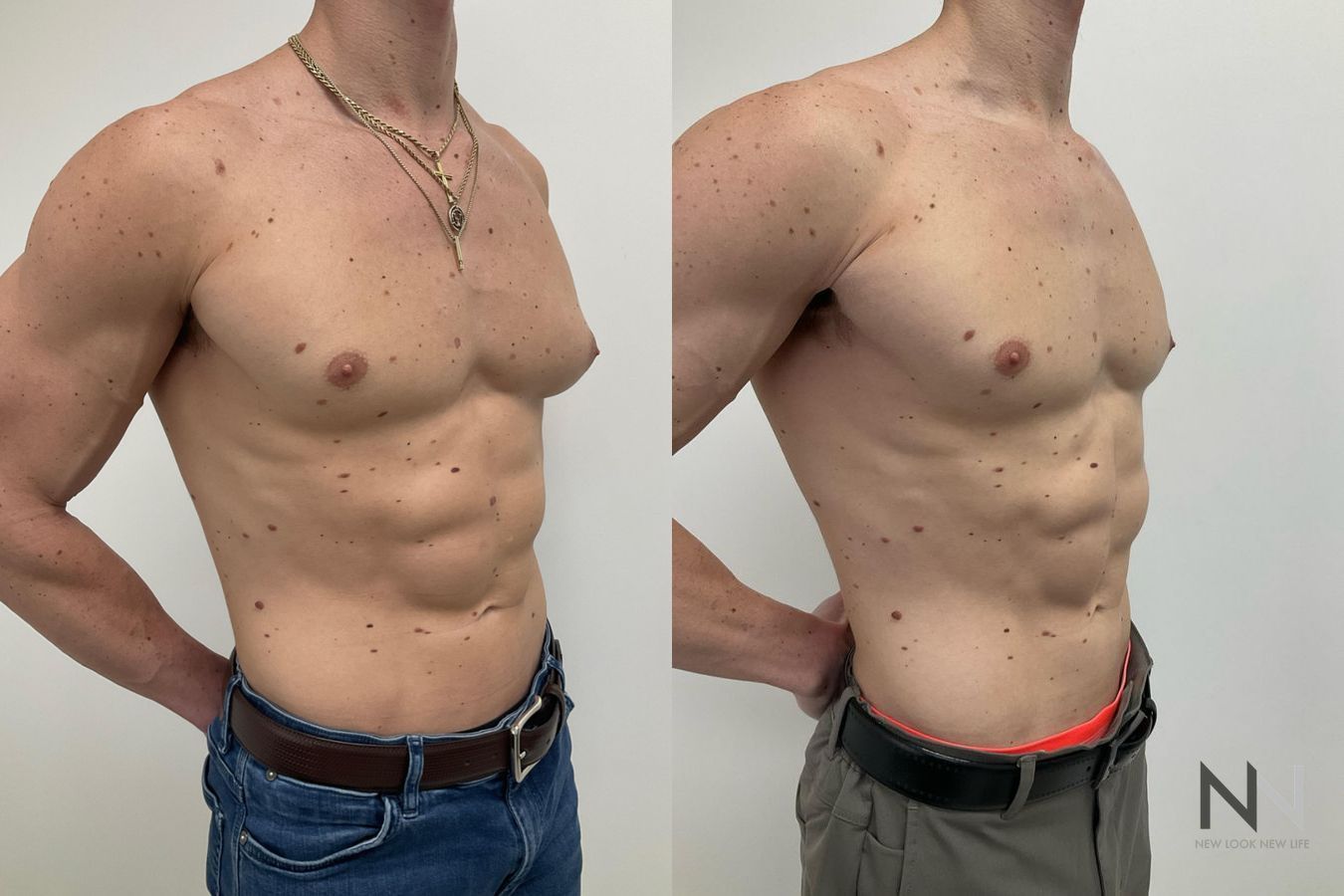 Gynecomastia before and after frontal view comparison - Angle 2