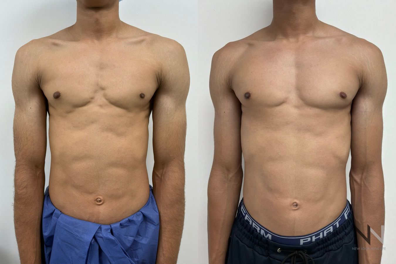 Gynecomastia surgery before and after showing improved male chest contour and symmetry following glandular tissue excision by Dr. Claudia Kim in NYC