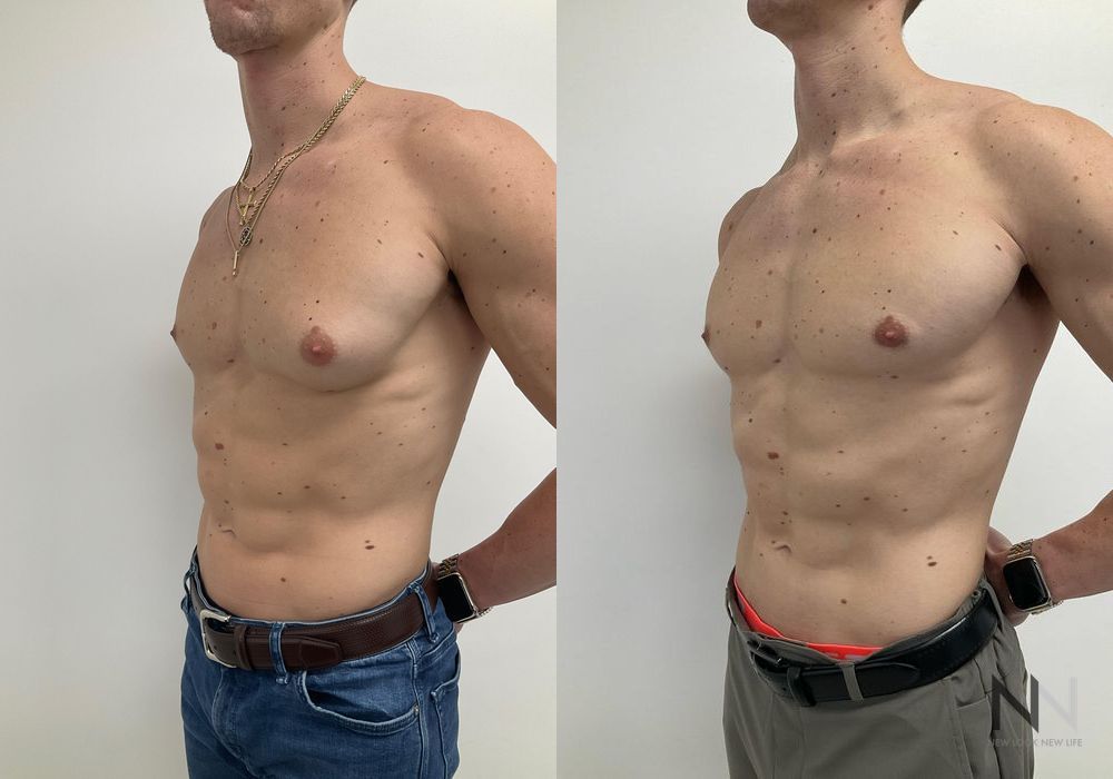 Gynecomastia - Thumbnail 4